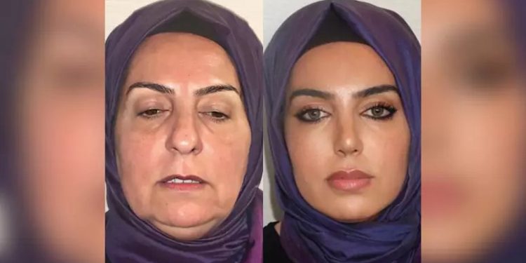 Resultado surpreendente de cirurgia plástica causa sensação nas redes sociais