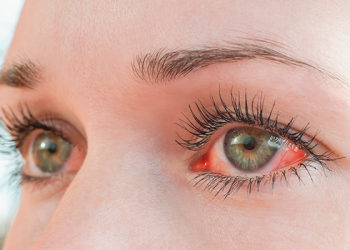 Alerta: Uso de óleo de rícino nos olhos pode ser perigoso, alertam especialistas