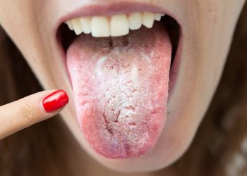 Língua Inflamada Indica Novas Variantes da Covid-19, Alerta Especialista